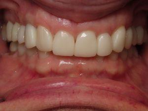Dean Cosmetic Dentistry smile makeover after — Knoxville, TN