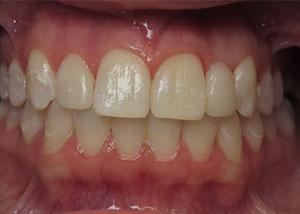 Dental Implants after at Dean Cosmetic Dentistry in Knoxville, TN