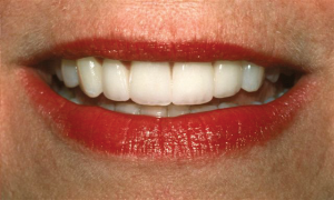 Gum Contouring after at Dean Cosmetic Dentistry in Knoxville, TN