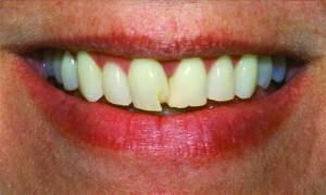 Gum Contouring before at Dean Cosmetic Dentistry in Knoxville, TN