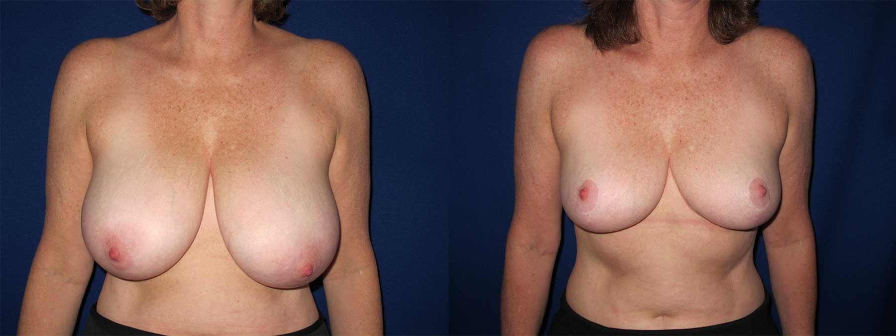 Peachtree Plastic Surgery breast reduction result — Atlanta, GA