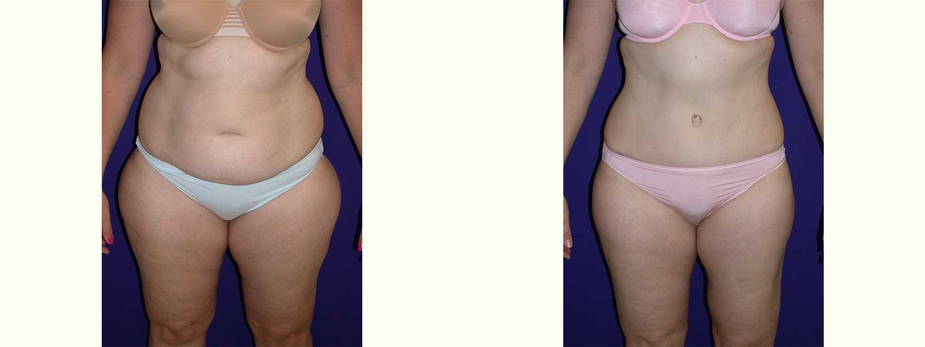 Peachtree Plastic Surgery tummy tuck result — Atlanta, GA