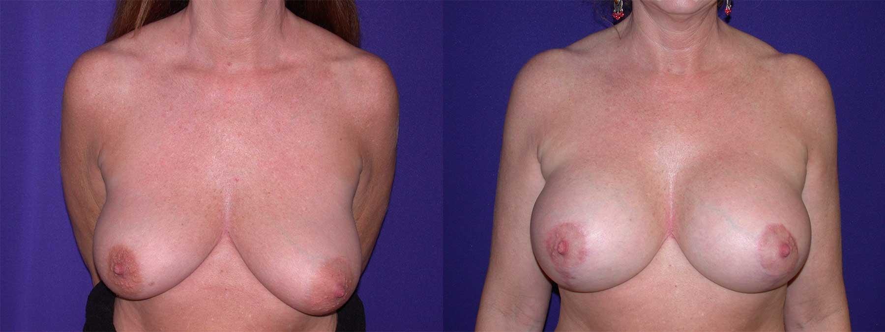 Peachtree Plastic Surgery breast lift result — Atlanta, GA