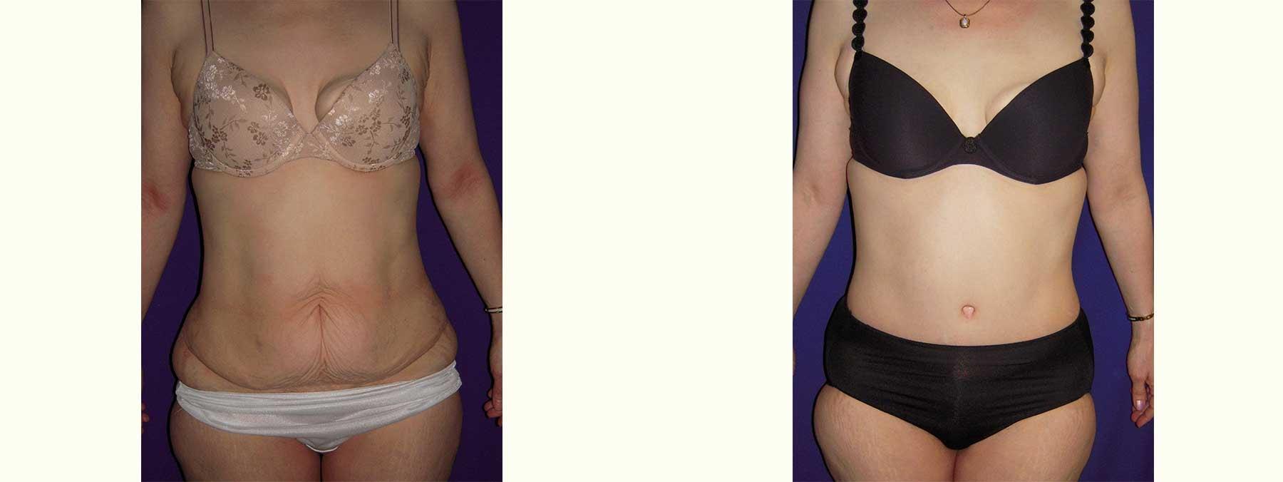 Peachtree Plastic Surgery tummy tuck result — Atlanta, GA