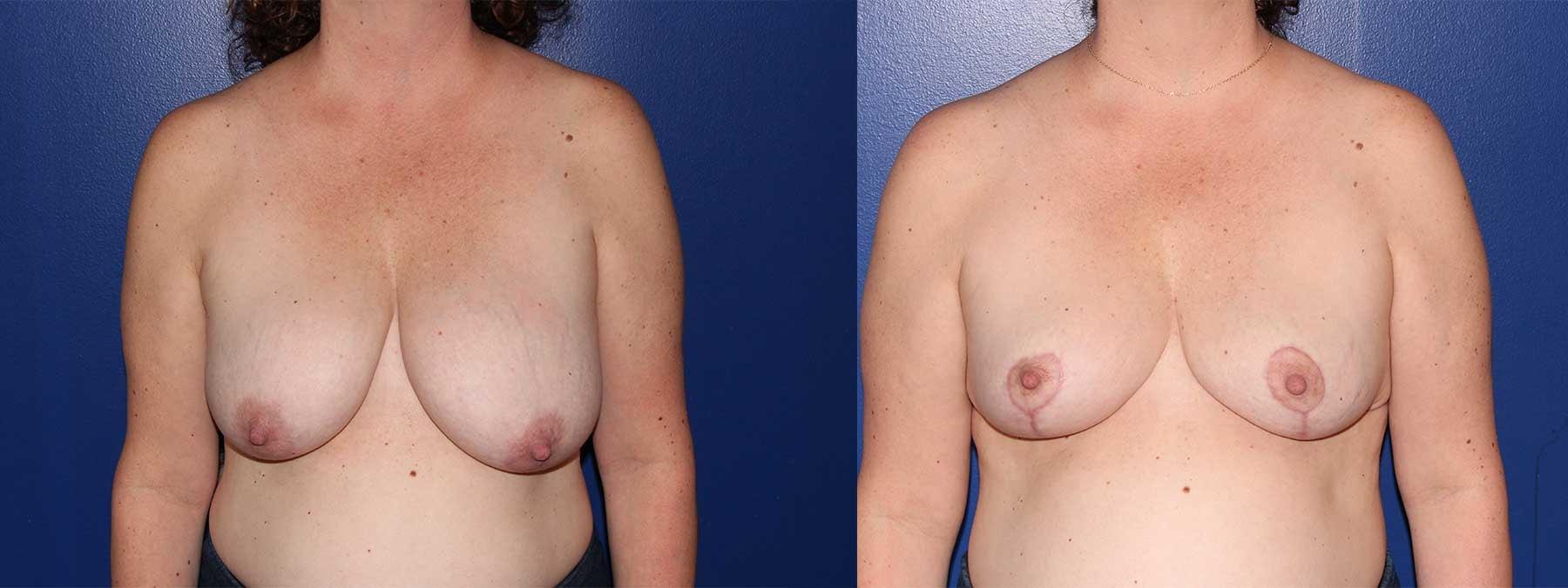 Peachtree Plastic Surgery breast reduction result — Atlanta, GA