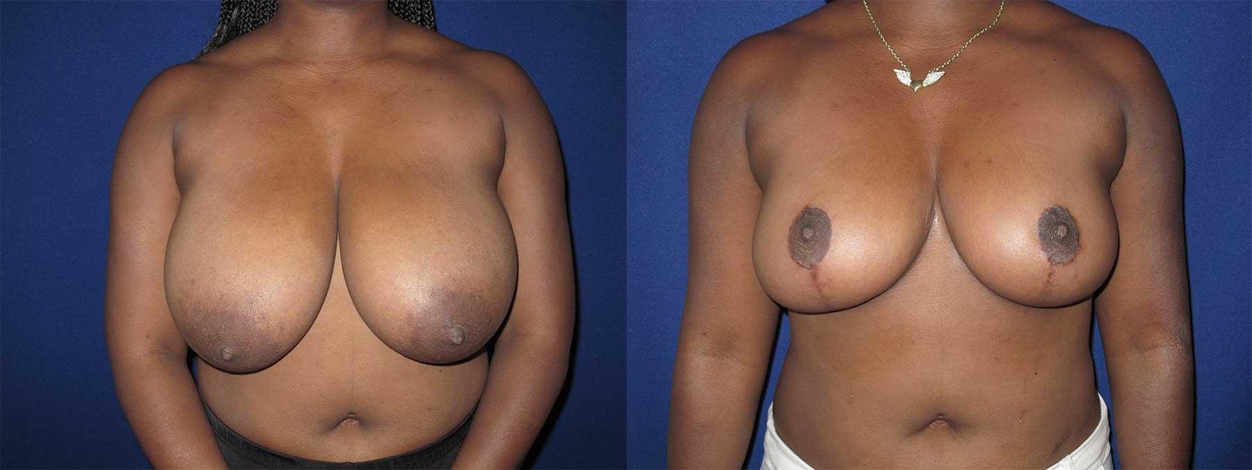 Peachtree Plastic Surgery breast reduction result — Atlanta, GA