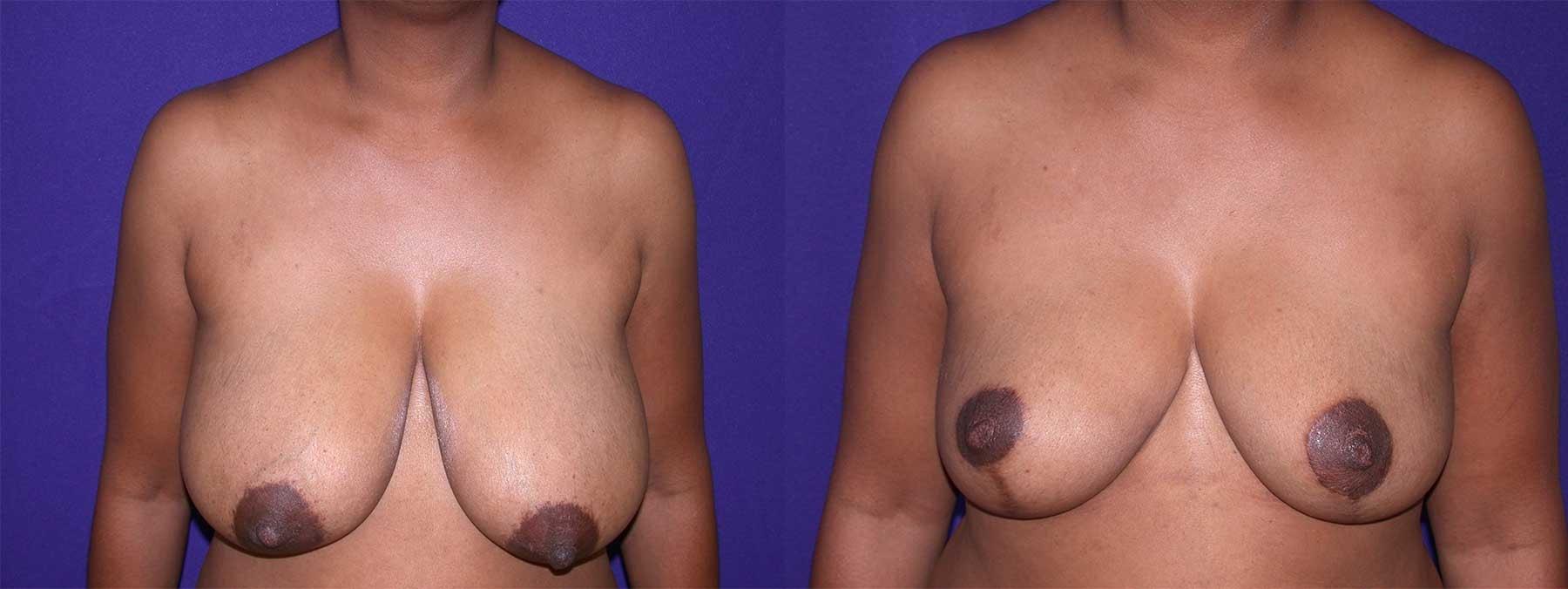 Peachtree Plastic Surgery breast reduction result — Atlanta, GA