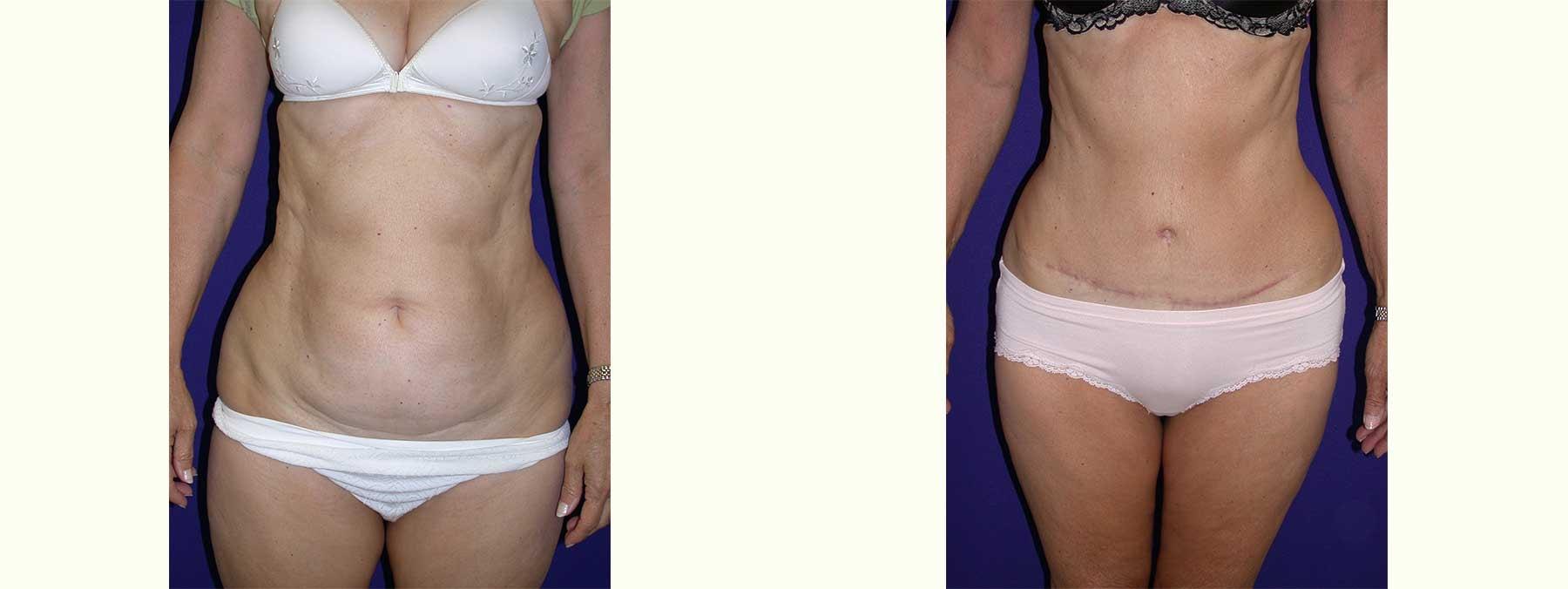 Peachtree Plastic Surgery tummy tuck result — Atlanta, GA