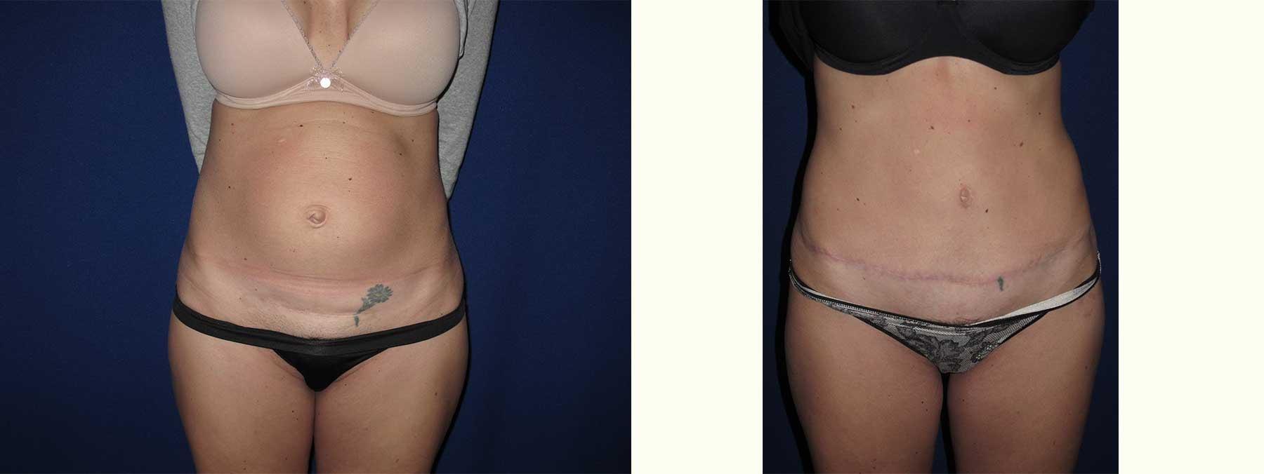 Peachtree Plastic Surgery tummy tuck result — Atlanta, GA