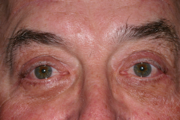 Blepharoplasty after at Klapper Eyelid & Facial Plastic Surgery in Carmel, IN