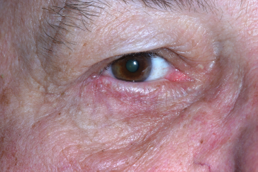 Klapper Eyelid & Facial Plastic Surgery after — Carmel, IN