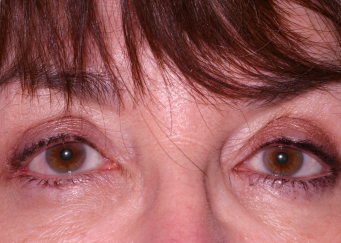 Klapper Eyelid & Facial Plastic Surgery after — Carmel, IN