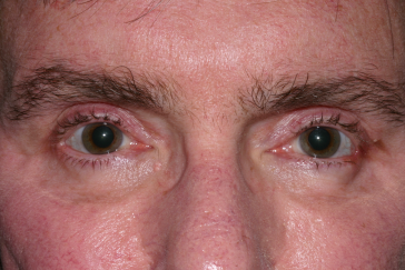 Blepharoplasty after at Klapper Eyelid & Facial Plastic Surgery in Carmel, IN