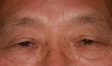 Blepharoplasty before at Klapper Eyelid & Facial Plastic Surgery in Carmel, IN