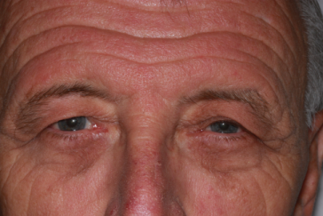 Blepharoplasty before at Klapper Eyelid & Facial Plastic Surgery in Carmel, IN