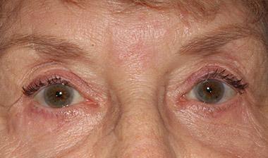 Brow Lift after at Klapper Eyelid & Facial Plastic Surgery in Carmel, IN