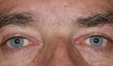Blepharoplasty after at Klapper Eyelid & Facial Plastic Surgery in Carmel, IN