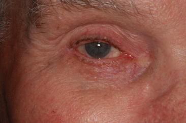 Klapper Eyelid & Facial Plastic Surgery after — Carmel, IN