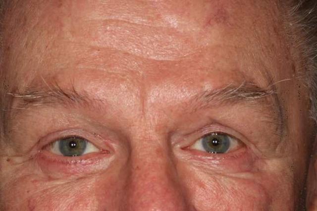 Blepharoplasty after at Klapper Eyelid & Facial Plastic Surgery in Carmel, IN