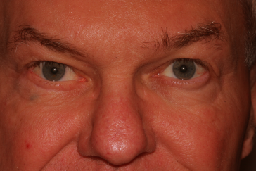 Klapper Eyelid & Facial Plastic Surgery after — Carmel, IN