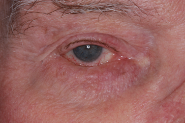 Blepharoplasty before at Klapper Eyelid & Facial Plastic Surgery in Carmel, IN