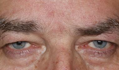 Blepharoplasty before at Klapper Eyelid & Facial Plastic Surgery in Carmel, IN