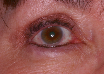 Blepharoplasty before at Klapper Eyelid & Facial Plastic Surgery in Carmel, IN