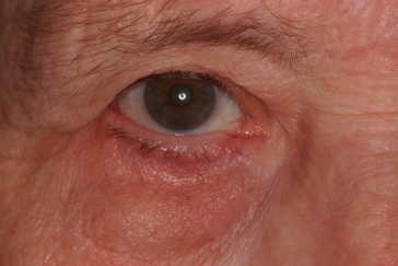 Klapper Eyelid & Facial Plastic Surgery after — Carmel, IN