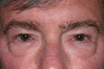 Blepharoplasty before at Klapper Eyelid & Facial Plastic Surgery in Carmel, IN