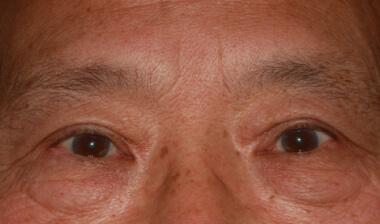 Blepharoplasty after at Klapper Eyelid & Facial Plastic Surgery in Carmel, IN