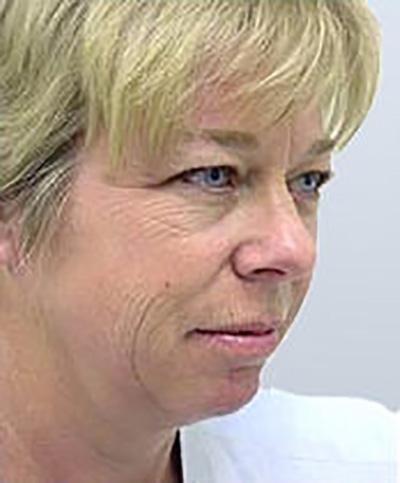Facelift before at Maan Kattash, MD, FACS in Irvine, CA