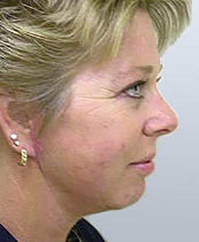 Maan Kattash, MD, FACS facelift after — Irvine, CA