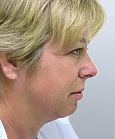 Facelift before at Maan Kattash, MD, FACS in Irvine, CA