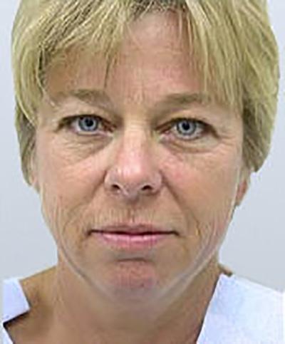 Facelift before at Maan Kattash, MD, FACS in Irvine, CA