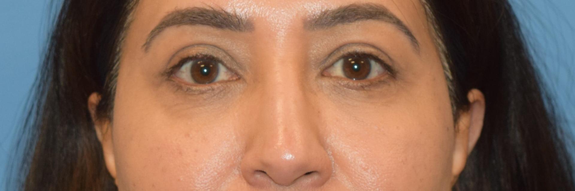 San Francisco Center for Facial Plastic, Reconstructive & Laser Surgery eyelid lift after — Mill Valley, CA