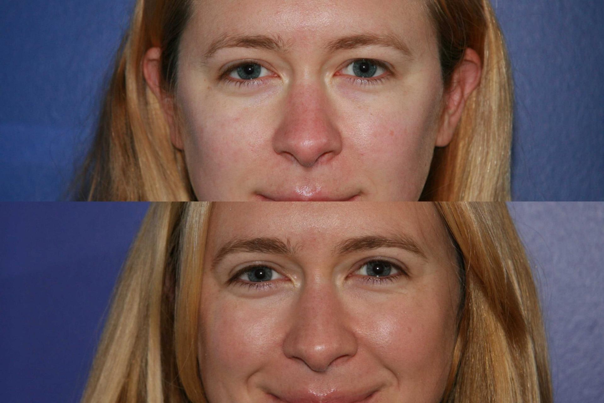 San Francisco Center for Facial Plastic, Reconstructive & Laser Surgery eyelid lift result — Mill Valley, CA