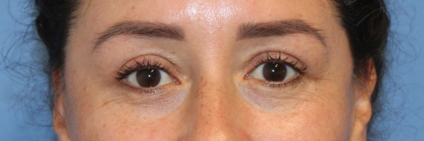 San Francisco Center for Facial Plastic, Reconstructive & Laser Surgery eyelid lift after — Mill Valley, CA