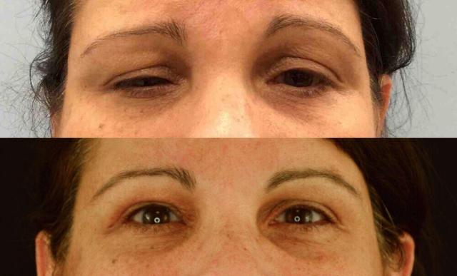 Blepharoplasty result at Jose Rodríguez-Feliz, MD in Coral Gables, FL