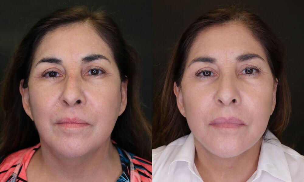 Jose Rodríguez-Feliz, MD neck lift result — Coral Gables, FL