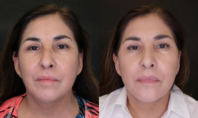 Neck Lift result at Jose Rodríguez-Feliz, MD in Coral Gables, FL