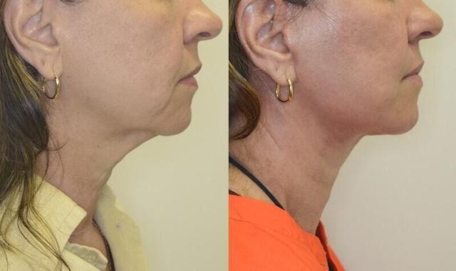 Neck Lift result at Jose Rodríguez-Feliz, MD in Coral Gables, FL