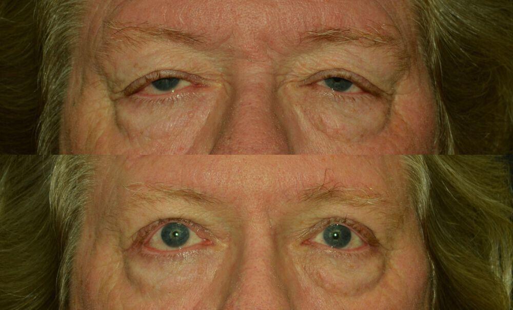 Jose Rodríguez-Feliz, MD blepharoplasty result — Coral Gables, FL
