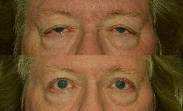 Blepharoplasty result at Jose Rodríguez-Feliz, MD in Coral Gables, FL