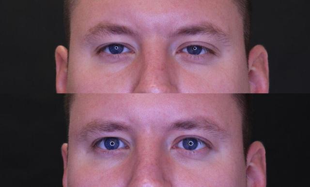Blepharoplasty result at Jose Rodríguez-Feliz, MD in Coral Gables, FL