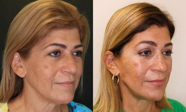 Facelift result at Jose Rodríguez-Feliz, MD in Coral Gables, FL