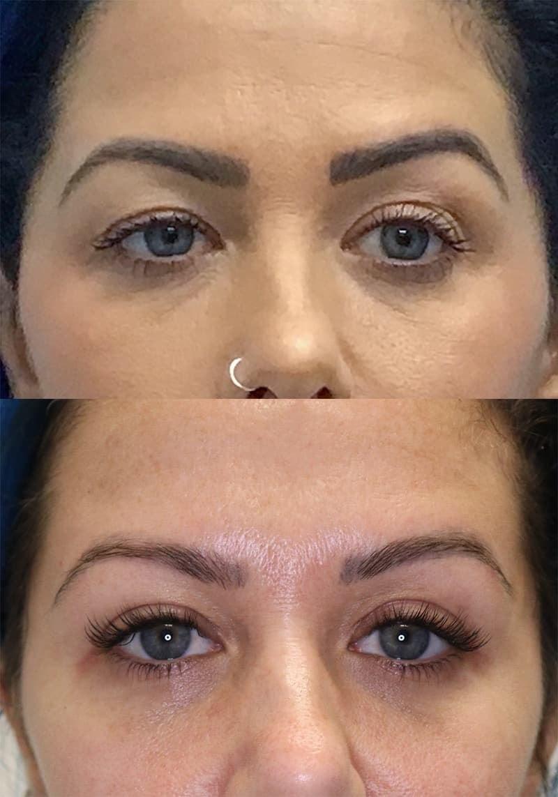 Jose Rodríguez-Feliz, MD blepharoplasty result — Coral Gables, FL