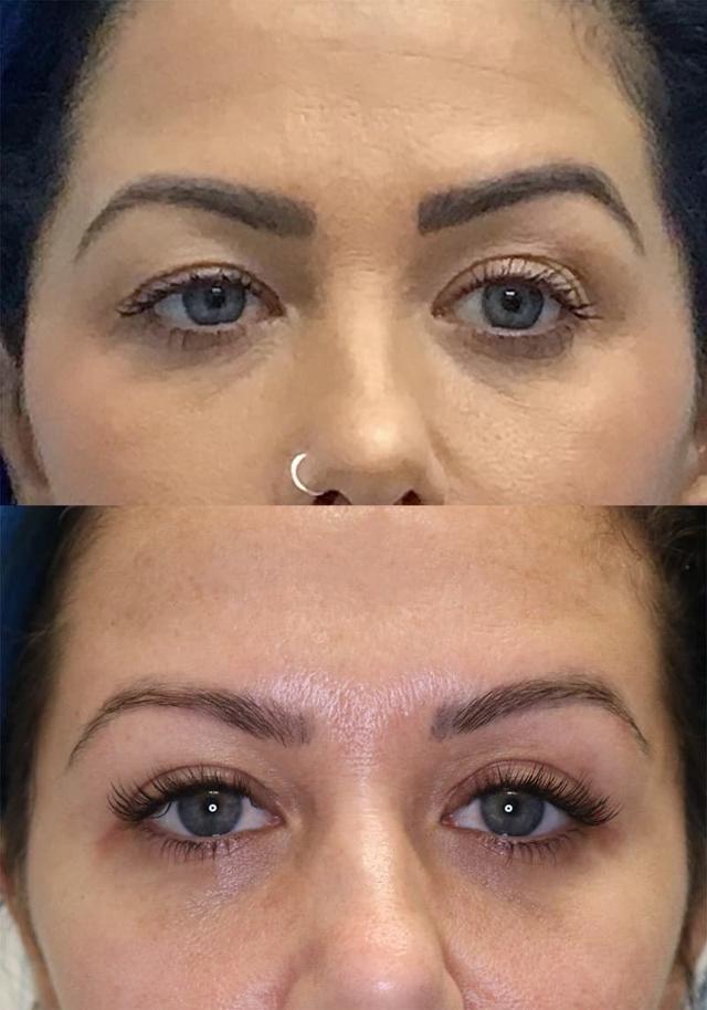 Blepharoplasty result at Jose Rodríguez-Feliz, MD in Coral Gables, FL
