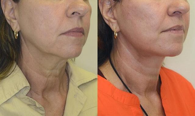 Neck Lift result at Jose Rodríguez-Feliz, MD in Coral Gables, FL