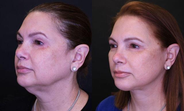 Neck Lift result at Jose Rodríguez-Feliz, MD in Coral Gables, FL