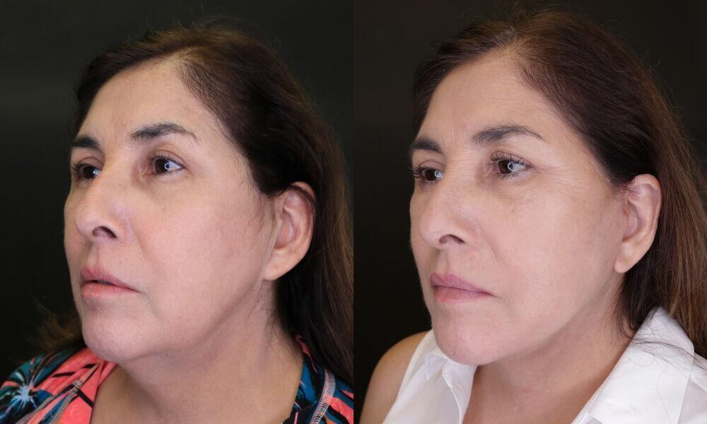 Jose Rodríguez-Feliz, MD neck lift result — Coral Gables, FL